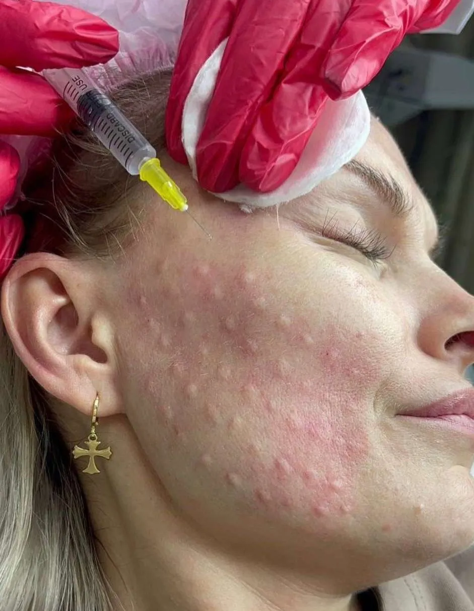 Skin booster treatment results